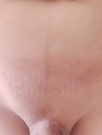 Fraktur Krümmung Narben geweberisse