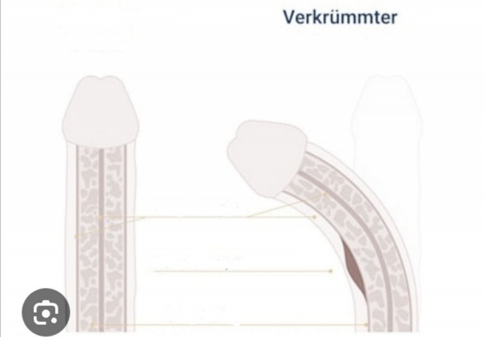 Fraktur am Gewebe des Schwellkörper s