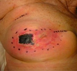 Brustgewebe Verletzungen