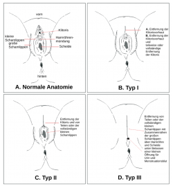 Weibliche Beschneidung